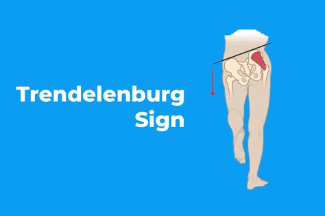 Trendelenburg is a medical sign and indicates gluteal or hip abductor weakness. For people who have a weakness of the hip abductor system for any reason (such as congenital dislocation of the hip joint) when standing, if the leg on the healthy side is lifted from the ground, the hip on the healthy side turns downward, and the trunk of the patient deviates to the opposite side. The walking of these people is called Trendelenburg walking. These people frequently bend to the sides while walking. Gluteus Minimus, Hip Dislocation, Muscle Belly, Hip Abduction, Medical Sign, Motor Neuron, Hip Surgery, Gluteus Medius, Body Health