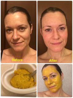 I made a tumeric and coconut oil mask, and the results were insane!! So easy. Just mixed coconut oil and tumeric into a paste and left it in for about 20 minutes. Great to do before a special occasion. It's supposed to be good for wrinkles, dark circles, red blotches and even unwanted hair removal. Pretty cool!! Tumeric And Coconut Oil, Coconut Oil Mask, Coconut Oil Hair Mask, Tumeric Face Mask, Coconut Oil Hair, Beauty Remedies, Homemade Face Masks, Skin Remedies, Unwanted Hair Removal