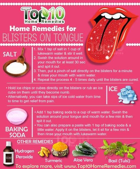 Home Remedies for Blisters on Tongue. You can try some natural #homeremedies to help alleviate the pain and inflammation caused b tongue blisters. Here are #top10homeremedies to promote faster healing. Blister On Tongue, How To Heal Blisters, Tongue Sores, Top 10 Home Remedies, Canker Sore, Tongue Health, Holistic Remedies, The Tongue, Cold Sore