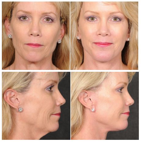 The Ponytail Lift™: Not Your Average Facelift - Los Angeles, CA | Kao Plastic Surgery Ponytail Lift Surgery, Ponytail Facelift, Ponytail Lift, Plastic Surgery, Surgery, Anti Aging, Angeles, Beauty, Los Angeles