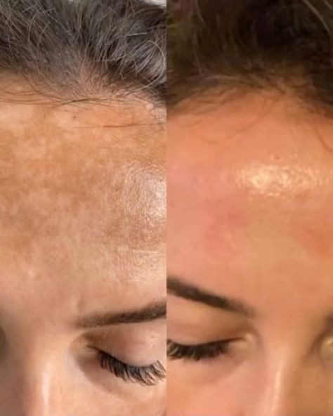 Microneedling Before And After, Best Stretch Mark Removal, Facial Before And After, For Brightening Skin, Stretch Mark Removal Cream, Acne Scarring, Beautiful Skin Care, Brightening Skin, Body Acne