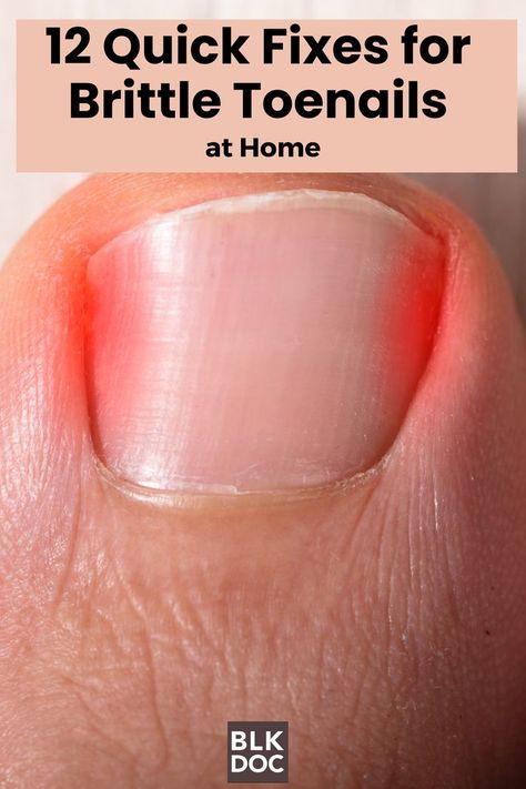 Brittle Toenails at Home Brittle Toenails, Toenail Health, Black Doctor, Nail Health, Find Work, Health Problems, Toe Nails, A Black, You Nailed It