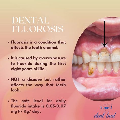 Dental Fluorosis, Dental Facts, Tooth Enamel, Conditioner