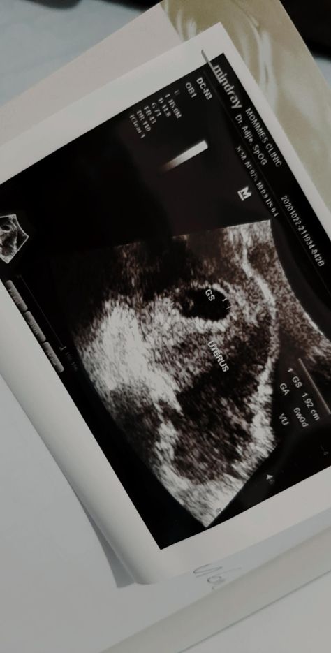 Hasil Usg Kandungan, Usg Kehamilan, Hasil Usg, Baby Ultrasound Pictures, Arte Ganesha, Baby Ultrasound, Story Fake, Ultrasound Pictures, Ultrasound