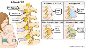 Spina bifida St Philopateer, Spina Bifida Awareness, Scientific Poster, Spinal Fluid, Chiari Malformation, Spina Bifida, Cerebrospinal Fluid, Unborn Baby, Healthcare Quality