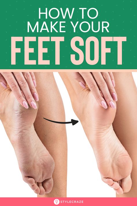 Smelly Feet Remedies, Soft Feet Remedy, Cracked Feet Remedies, Dry Feet Remedies, Cracked Heel Remedies, Soft Heels, Cracked Heels, Foot Cream, Foot Care