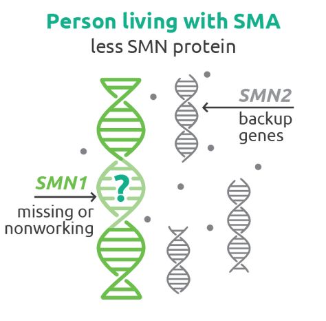 What Is Spinal Muscular Atrophy (SMA)? Spinal Muscular Atrophy, Belly Breathing, Motor Neuron, Genetic Diseases, Gene Therapy, Respiratory Infection, Nerve Cell, Hand Hygiene, Spinal Cord