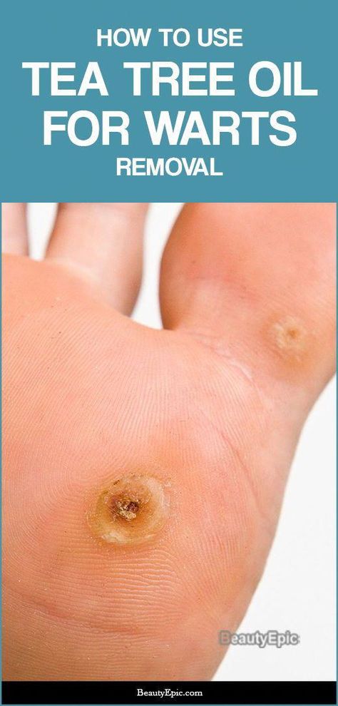 #HomeRemediesForCough What Causes Warts, Skin Tags Removal, Natural Remedy For Cough, Natural Remedies For Sore Throat, Warts On Hands, Wart Remover, Home Remedies For Cough, For Sore Throat, Remove Warts