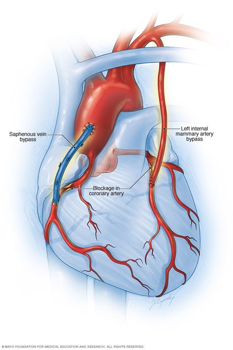 Cath Lab Nursing, Coronary Artery, Human Body Facts, Penyakit Jantung, Basic Anatomy And Physiology, Cardiac Nursing, Heart Care, Bypass Surgery, Heart Muscle