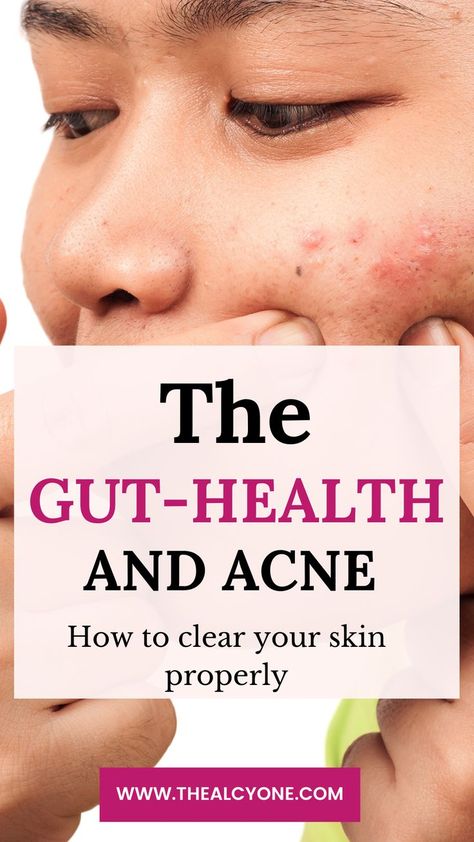 Back Acne Remedies, Acne Diet, Forehead Acne, Gut Health Diet, How To Get Rid Of Pimples, Skin Detox, Hormonal Acne, Acne Remedies, How To Get Rid Of Acne