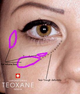 Diagram of tear trough deformity and how to get rid of dark under eye circles post. How To Get Rid Of Tear Troughs, Tear Trough Makeup, Botox Funny, Face Injections, Dermal Fillers Lips, Dark Under Eye Circles, Pdo Threads, Under Eye Primer, Medical Aesthetician