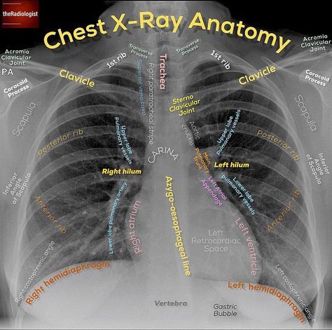 👨🏽‍💻Here’s a recap of three posts on Chest X-Ray anatomy from the last few months ⁣ ⁣ ⁣ 👨🏽‍💻The Chest X-Ray is one of the most powerful tools in medicine, and can diagnose a wide array of conditions ⁣ ⁣ 👨🏽‍💻The abnormalities you see can be obvious but it takes focus and a good understanding of the anatomy to pick up some of the more subtle findings ⁣ ⁣ 👨🏽‍💻As always I STRONGLY ADVISE using a SYSTEM to review Chest X-rays - the format and order of your system does not matter too ... Radiography Student, Medical Radiography, Radiologic Technology, Radiology Student, Radiology Technician, Radiology Imaging, Radiology Tech, Medical Student Study, Medicine Student