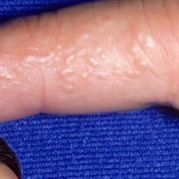 Itchy Bumps On Skin, Finger Hands, Bumpy Skin, Skin Condition, The Palms, Sun Exposure, Skin Conditions, In The Winter, Hot Summer