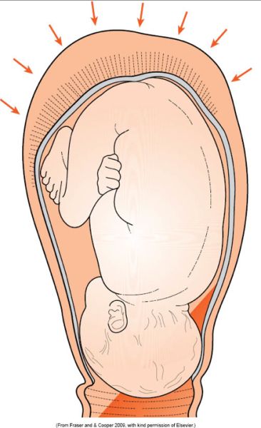 One of my failings as a midwife is my inability to assess the strength and effectiveness of a uterine contraction. This presents a problem in the hospital setting as midwives are often asked &#8216… Labor Contractions, Contractions Labor, Doula Training, Doula Business, Student Midwife, Prepare For Labor, Pregnancy Labor, Childbirth Education, Birth Doula