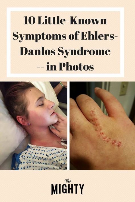 Ehlers Danlos Syndrome Symptoms, Elhers Danlos Syndrome, Ehlers Danlos Syndrome Hypermobility, Ehlers Danlos Syndrome Awareness, Mast Cell Activation Syndrome, Ehlers Danlos, Ehlers Danlos Syndrome, Rare Disease, Invisible Illness