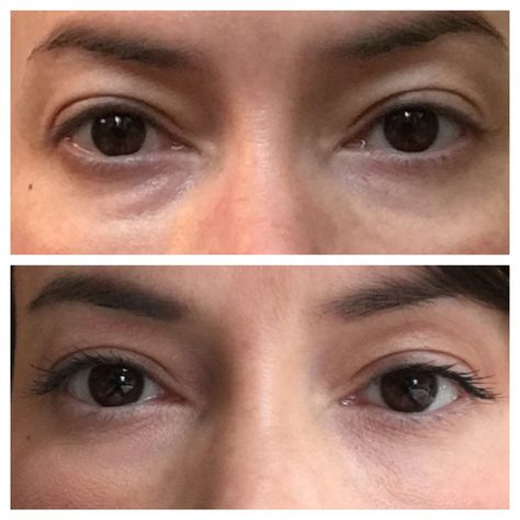 Quick, easy and lasting option for the undereye area using Platelet Rich Plasma/Platelet Rich Fibrin Matrix (PRP/PRFM). All-natural results without the risk of lumpiness, blue shadowing, or unnatural appearance that can sometimes appear with dermal fillers. #TuesdayMotivaton #tuesdayvibe #dermalfillers #PRP #undereyefiller #skin #cincinnati #medspa #antiaging Prp Undereye, Mini Fountain, Achy Joints, Under Eye Fillers, The Fountain Of Youth, Platelet Rich Plasma, Fountain Of Youth, The Fountain, Dermal Fillers