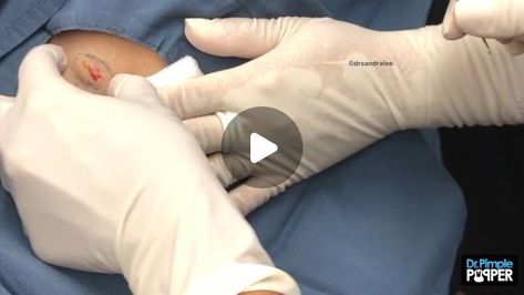 16K likes, 112 comments - drpimplepopper on June 9, 2019: "Steatocystoma like fire butter... 🙌🏼 🔥 #drpimplepopper". Boil Popping Videos, Bot Fly, Pineapple Water, Sandra Lee, Blackheads, Pineapple, Butter, Water, On Instagram