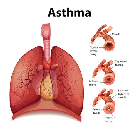 Free vector comparison of healthy lung a... | Free Vector #Freepik #freevector #lungs #lung-disease #asthma #anatomy Throbbing Headache, How To Help Nausea, Severe Asthma, Healthy Lungs, Chronic Obstructive Pulmonary Disease, Asthma Symptoms, Healthy Morning Routine, Pulmonary Disease, Lung Disease