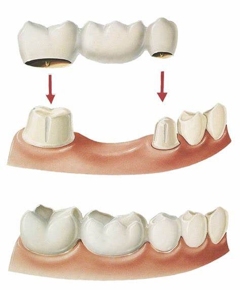 Dental Bridge Cost, Dental Posters, Bridge House, Dental Videos, Dental Facts, Teeth Implants, Dental Bridge, Dental Veneers, Dental Art