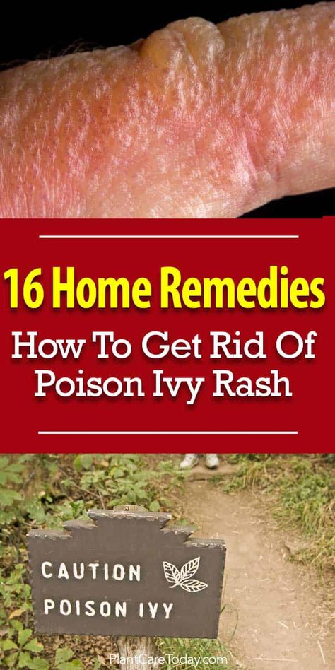 Everyone wants to avoid contact with poison ivy or look for ways to get rid of poison ivy rash but the plant is everywhere - 16 home remedies [LEARN MORE] Poison Ivy Home Remedies, Poison Ivy Remedies, Poison Ivy Rash, Holistic Health Remedies, Home Remedies For Acne, Cold Home Remedies, Holistic Remedies, Cough Remedies, Beauty Remedies