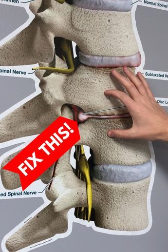 Bulging Disc Exercises, Dr Rowe, K Tape, Stomach Exercises, Back Relief, Bulging Disc, Pinched Nerve, Sciatica Exercises, Sciatica Relief