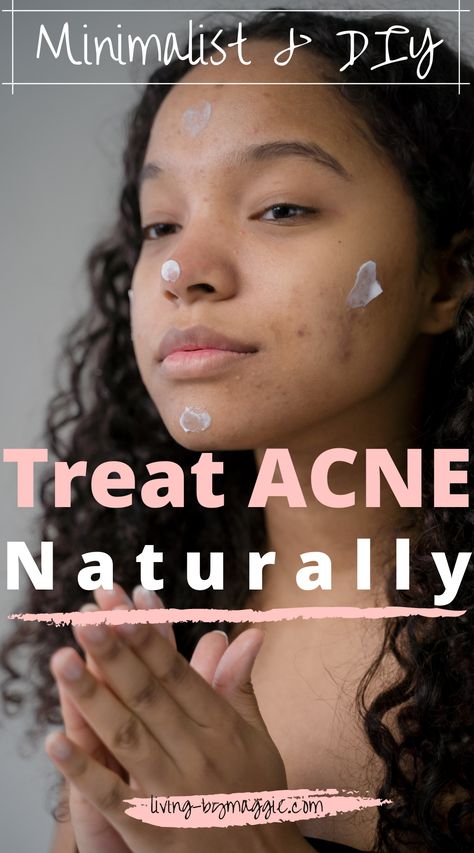 Treat hormonal acne naturally following a simple, but effective DIY routine. Simple diet guidelines, the most effective supplement you should absolutely be taking, and a handful of natural but highly effective DIY ingredients. This routine cleared my acne in 3 months! | Treat acne naturally | Minimalist skincare | Acne skincare routine | DIY Skincare | Anti-acne diet | #acne #acnetips #clearacne #hormoneacne Treat Hormonal Acne, Treat Acne Naturally, Teenage Acne, Face Mapping Acne, Forehead Acne, Acne Prone Skin Care, Bad Acne, Acne Skincare Routine, Natural Acne Remedies