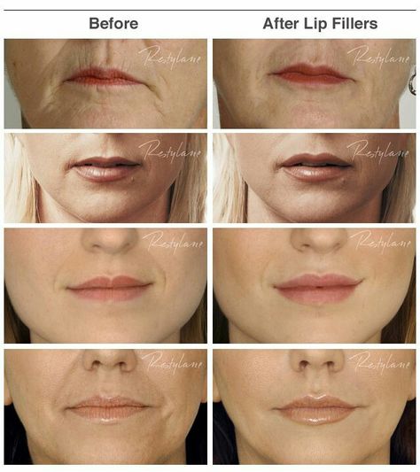 subtle lip aug Lip Injections Juvederm, Before And After Lip Fillers, Restylane Lips, After Lip Fillers, Lip Fillers Shapes, Dermal Fillers Lips, Juvederm Lips, Botox And Fillers, Face Fillers