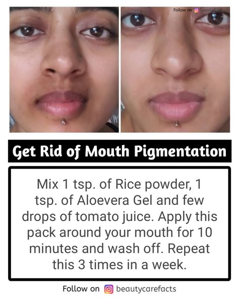 Get rid of mouth pigmentation Mouth Pigmentation, Beauty Treatments Skin Care, Ayurvedic Remedies, Rice Powder, Rice Water, Tomato Juice, Vitamin E Oil, Aloe Vera Gel, Beauty Treatments