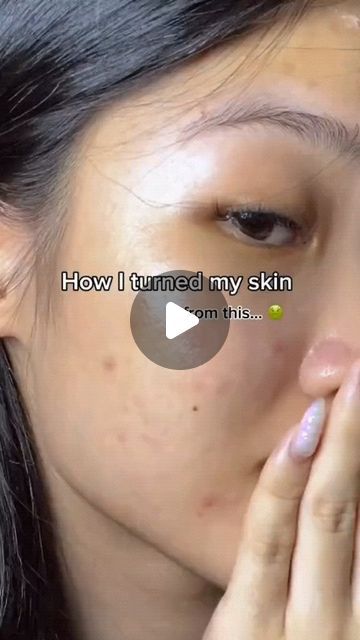 Honey On Face, How To Get Clear Skin, Honey For Face, Aloe Vera Gel For Face, Pimple Free Skin, Homemade Face Wash, Milk Mask, Aloe Vera For Face, Aloe Vera For Skin