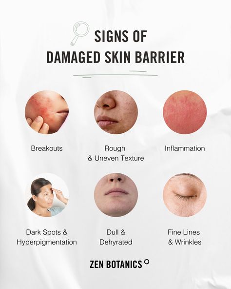 To Remove Pimples, Damaged Skin Barrier, Remove Pimples, Gross Things, Skin Facts, Bad Acne, Skin Care Business, Skin Aesthetics, How To Remove Pimples