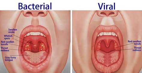 Pharyngitis Swollen Uvula, Chronic Sore Throat, Swollen Tonsils, Throat Remedies, Sore Throat Remedies, Throat Infection, Strep Throat, Sore Throat, Homeopathy