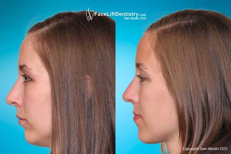 Correct a small chin, misaligned jaw and overbite, and enhance the shape of the face without chin augmentation surgery or braces with no downtime. Receding Chin Hairstyles, Small Chin Hairstyles, Small Jawline Faces, No Chin Faces, Chin Enhancement Before After, Weak Chin Profile, Receding Jawline, Small Jawline, Weak Chin Hairstyles