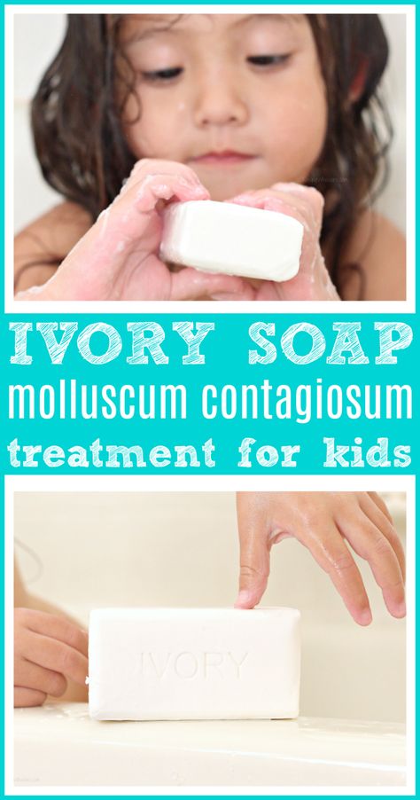 Using Ivory Soap to Treat Molluscum Contagiosum in Kids | My doctor recommended using Ivory for my child's diagnosis #ivorysoap #kids #health #kidshealth Molluscum Contagiosum, Herbal Soap, Ivory Soap, Gastrointestinal System, Childhood Obesity, How To Make Homemade, Lungs, Kids Health, Muscle Mass