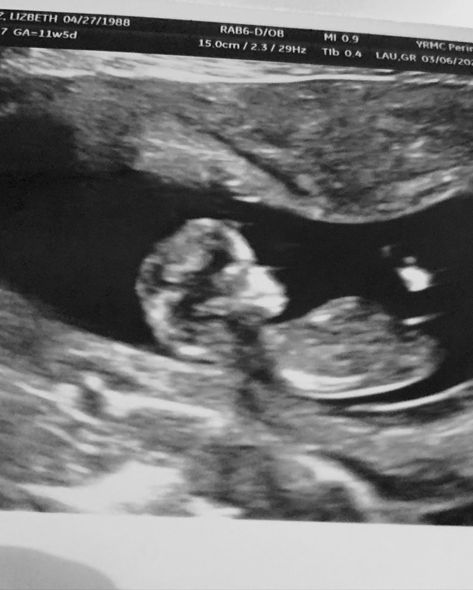 Baby boy ultrasound at 12 weeks pregnant 12weeks Pregnant, 8 Weeks Pregnant Ultrasound, 12 Weeks Pregnant Ultrasound, Boy Ultrasound, 12 Week Ultrasound, Baby Ultrasound Pictures, Pregnant Ultrasound, 12 Weeks Pregnant, Baby Ultrasound