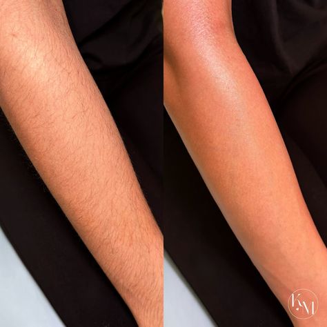 full arm wax service 🤎 . i performed this service using soft wax & muslin strips. i was able to remove every single hair without having to go over the same spot multiple times. soft wax is great for removing hair on larger body surface areas! 🧼 . she usually shaves, which is why her hair looked coarse. if she stays consistent with waxing every 4-6 weeks, her hair will start growing back slower & thinner over time. i loved being able to clean up her arms for her! the before & after was so ... Waxing Before And After, Full Body Wax, Why Her, Body Waxing, Esthetician, Hair Removal, Clean Up, Hair Looks, Full Body