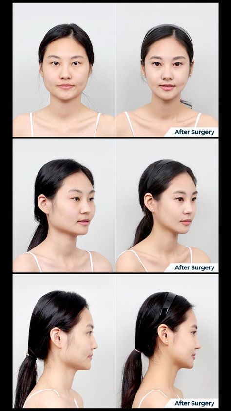 Before and After Cheekbone Reduction, Jaw Reduction and Genioplasty Jaw Reduction Surgery Before After, Cheek Reduction Surgery, Square Jaw Reduction, Face Plastic Surgery Before After, Browbone Reduction, Jaw Surgery Before And After, Plastic Surgery Before And After, Zygoma Reduction, Glow Up Before And After