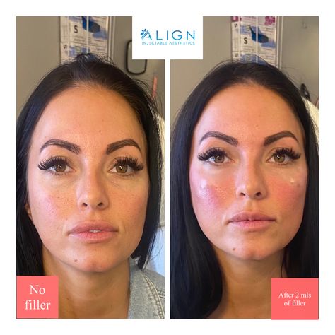 Midface Cheek Filler, Mid Cheek Filler, Cheek Filler Before And After, Undereye Filler Before And After, Cheekbone Filler, Cheekbone Filler Before And After, Under Eye Filler Before And After, Psych Np, Lower Face Lift