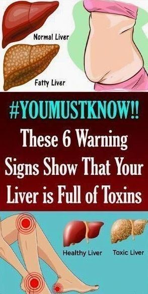 6 CLEAR WARNING SIGNS YOUR LIVER IS FULL OF TOXINS AND MAKING YOU FAT (HOW TO STOP IT) Natural Add Remedies, Skin Breaking Out, Women Health, Excessive Sweating, Liver Detox, Healthy Liver, Cardio Gym, Liver Health, Natural Health Remedies