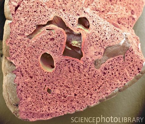 Lung tissue. Coloured SEM of a section through a lung, showing numerous alveoli (small holes) and a bronchus (upper centre). Alveoli are tiny airsacs that are the site of gas exchange, where oxygen from inhaled air is taken up by the blood, and carbon dioxide is released to be exhaled. Magnification: x20 when printed 10 centimetres wide. Gas Exchange, Lung Anatomy, Scanning Electron Microscope, Scanning Electron Micrograph, Microscopic Photography, Fearfully Wonderfully Made, Pulmonology, Microscopic Images, Painted Illustration