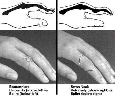 sketch of swan neck and boutonnier deformities in the hand pictured with cooresponding corrective orthoses Swan Neck Deformity, Geriatric Occupational Therapy, Physical Therapist Assistant, Finger Exercises, Adaptive Equipment, Swan Neck, Hand Therapy, Johns Hopkins, Occupational Therapist