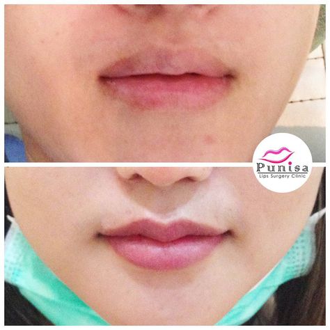 Korean Lip Surgery, Lip Plastic Surgery, Korean Surgery, Lip Reduction, Medical Learning, Lip Surgery, Korean Lips, Reduction Surgery, Rakul Preet Singh