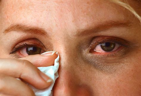 Woman Wiping Eyes Eye Allergy Relief, Eye Wash Solution, Allergy Eyes, Coconut Health Benefits, Watery Eyes, Itchy Eyes, Allergy Relief, Homeopathic Remedies, Dry Eyes