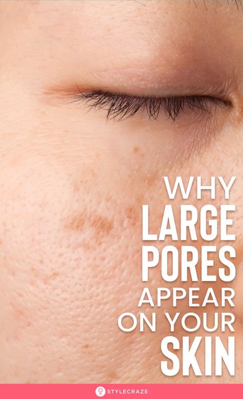 Reducing Pore Size On Face, How To Reduce Large Pores On Face, Large Pores On Face Products, Facial Pores Remedies, Get Rid Of Big Pores On Face, Decrease Pores On Face, Cleaning Pores On Face, How To Reduce Sebum Production, Skincare Routine For Large Pores