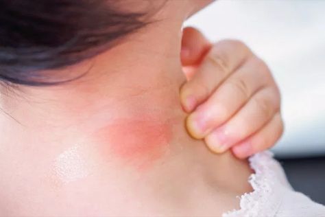 17 Signs Your Bug Bite Is Something Serious | Best Life Infected Bug Bite, Red Bug Bites, Love Bite Boyfriend, Types Of Bug Bites, Diy Mice Repellent, Chronic Hives, Spider Bite, Love Bite, Bug Bite