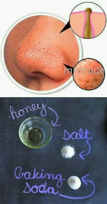 Get rid of black heads Natural Blackhead Remover, Beauty Basket, Get Rid Of Pores, Obličejové Masky, Blackhead Remover Diy, Blackheads Removal, Clear Skin Tips, Diy Skin, Healthy Skin Care