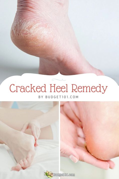 Soft Feet Remedy, Cracked Fingertips, Expensive Heels, Cracked Heel Remedies, Cracked Heels, Rough Heels, Cracked Skin, Workout Pictures, Natural Treatments