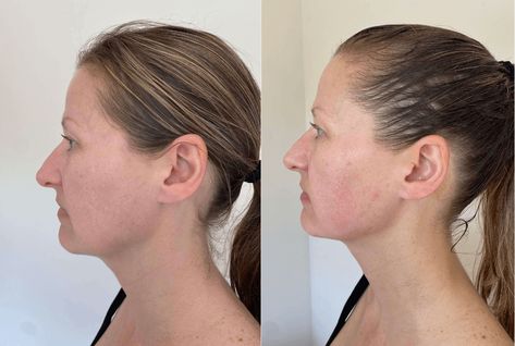 Sculpting Inner Mouth Buccal Face Massage: Benefits and Before/After Results | Minimal Beauty Buccal Massage Before And After, Face Massage Before And After, Face Massage Benefits, Buccal Massage, Face Sculpting, Jaw Clenching, Minimal Beauty, Ligaments And Tendons, Massage Benefits