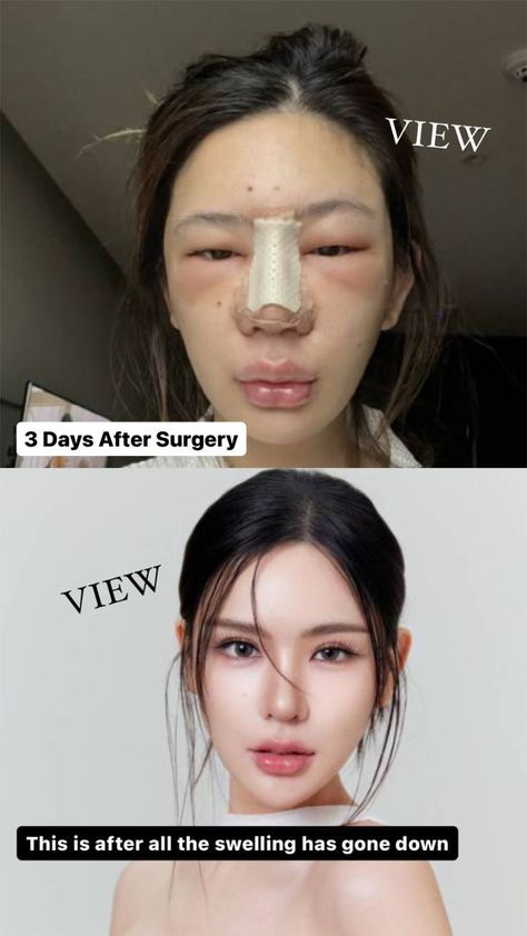 Plastic surgery Fails Korea Rhinoplasty, Plastic Surgery Fails, Kpop Plastic Surgery, Jaw Reduction Surgery, Square Jaw, V Line Surgery, Celebrity Surgery, Plastic Surgery Korea, Plastic Surgery Fail