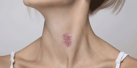 Hickies Girls, How To Cover A Hickey Fast, How Long Do Hickeys Last, How To Get Rid Of Hickeys, How To Get Rid Of A Hickey Fast, Hickey Cover Up Makeup, How To Get Rid Of Hickeys Quickly, How To Cover A Hickey With Makeup, Hickey Removal Quick