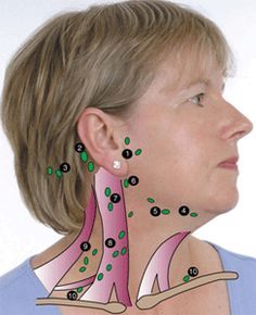 Example of Lymph Nodes in Head and Neck Lymph Glands, Abnormal Cells, Slim People, Lymph Fluid, Lymph Massage, Lymph System, Squamous Cell, Lymph Drainage, Lymph Nodes